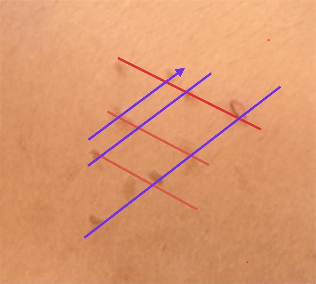 女童臉上驚見「紅疹排排站」誤當被蟲咬 醫曝「這1物」惹的禍:換掉才會好!