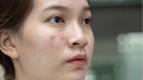 痘痘反覆出現？角質狀態與保濕失衡也是常見影響因素之一