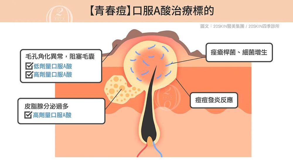 口服 A 酸真的很可怕嗎？皮膚科帶你一次解析常見副作用與注意事項