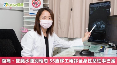 腹痛、雙腿水腫別輕忽 55歲移工確診全身性惡性淋巴瘤