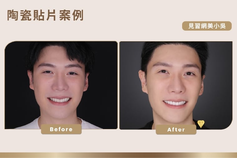 年底聚會拍照更上鏡？ 醫：矯正搭配貼片美齒一次到位