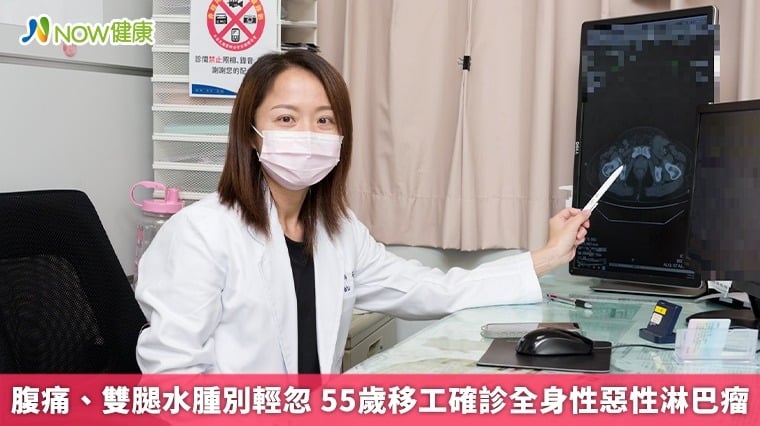 腹痛、雙腿水腫別輕忽 55歲移工確診全身性惡性淋巴瘤