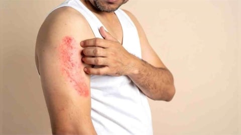 用藥安全⎪致死率達3成的「史蒂芬強森症候群」是什麼？ 出現6大症狀應立刻就醫！