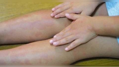 4歲女童全身紅疹染梅毒！　感染原因竟是「奶奶用嘴餵食」