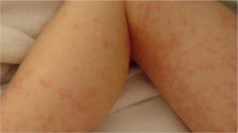 4歲女童「突全身紅疹」竟染上梅毒！「奶奶1舉動害了她」醫籲4感染風險要注意