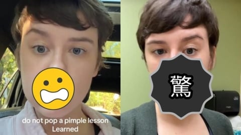女網紅擠一顆痘痘竟「半臉癱瘓」！醫警告「這1處」最危險：死亡三角區