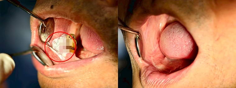 牙齦紅腫可能不只是牙周病 逾2週未癒當心牙齦癌警訊