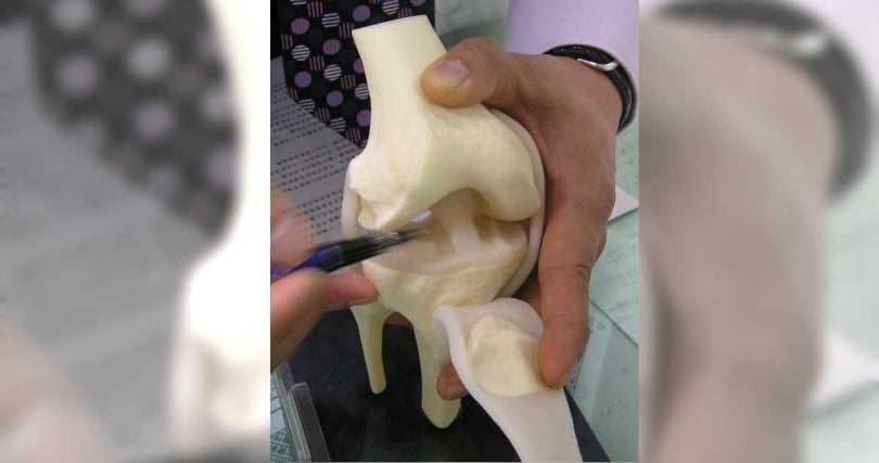 CTWANT調查，保戶在接受治療膝蓋受傷、退化等所使用的「羊膜異體移植（粉劑生長因子）」，為保險公司實支實付險「拒賠」的一大項目，圖為半月軟骨示意圖。（圖／報系資料照）