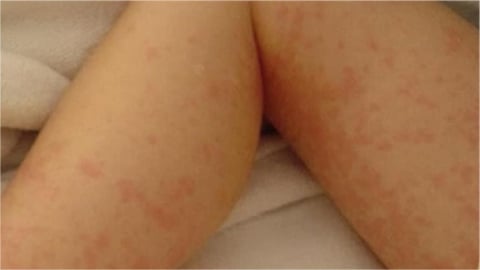 梅毒升溫「今年全台增9千例」!「這族群」暴增最明顯 疾管署示警