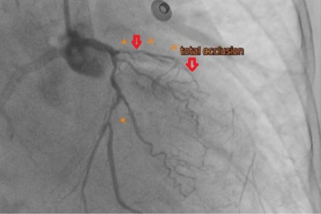 關鍵血管阻塞 「複合式冠脈血流重建」搶救可逆心肌！胸悶、呼吸喘應留意