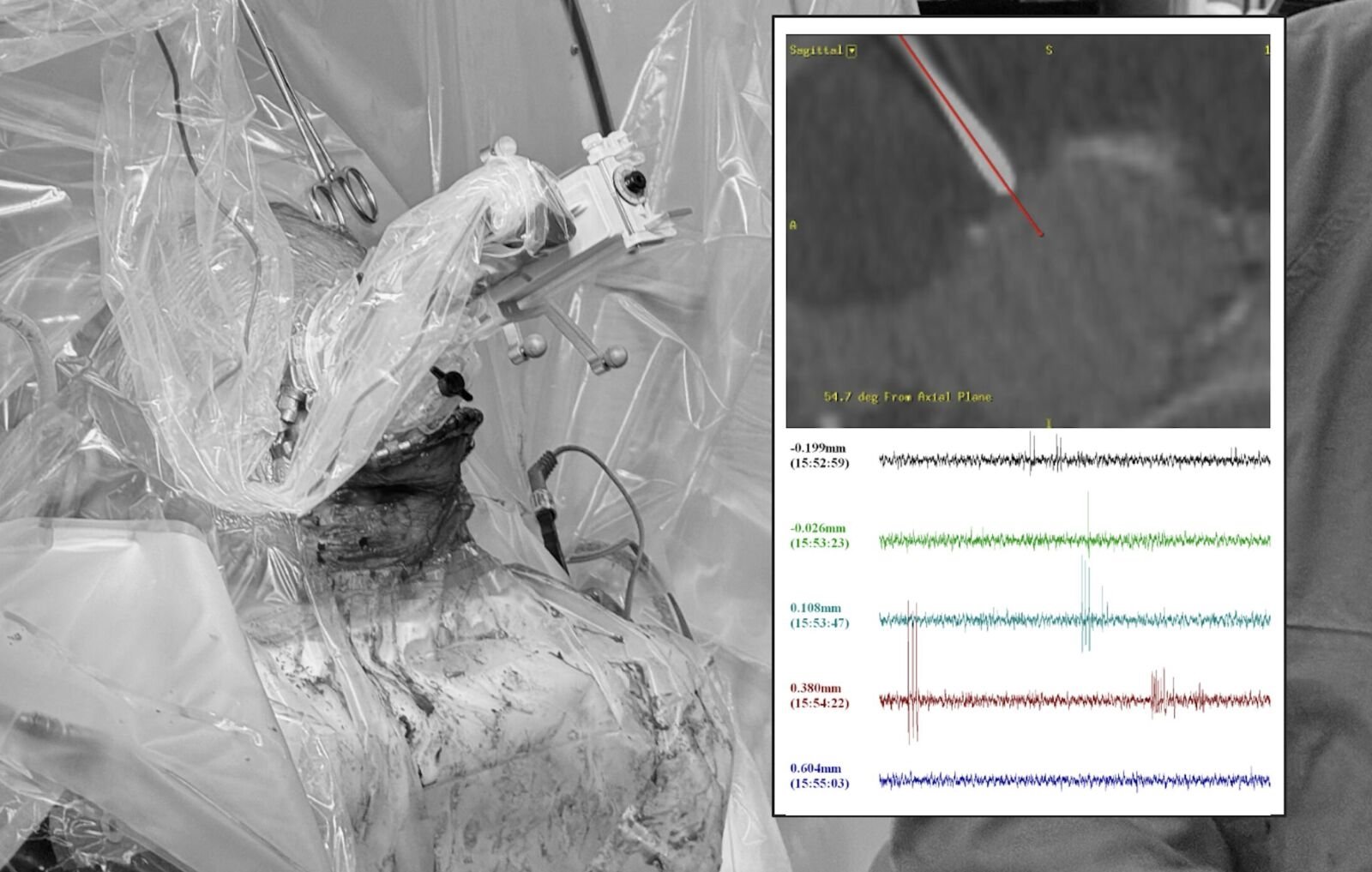 他活到20歲「人生一半時間在癲癇」 台大完成全台首例最新型手術緩解 6