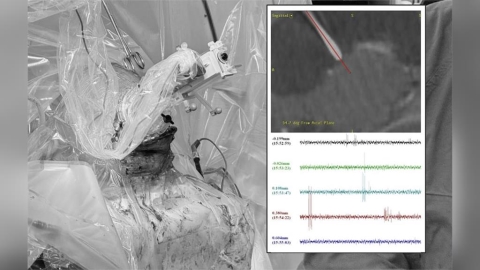 他活到20歲「人生一半時間在癲癇」   台大完成全台首例最新型手術緩解