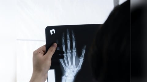 吸菸或曝露二手菸「傷骨」  衛福部警告：提高骨折、骨鬆風險