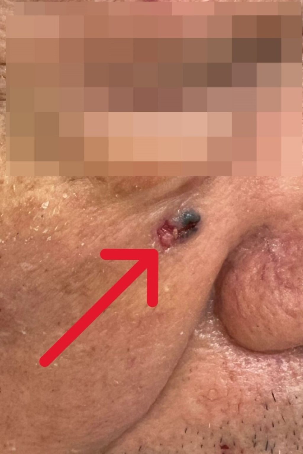 台灣每年3千6百人確診皮膚癌!小心臉上黑斑竟是「皮膚基底細胞癌」 !