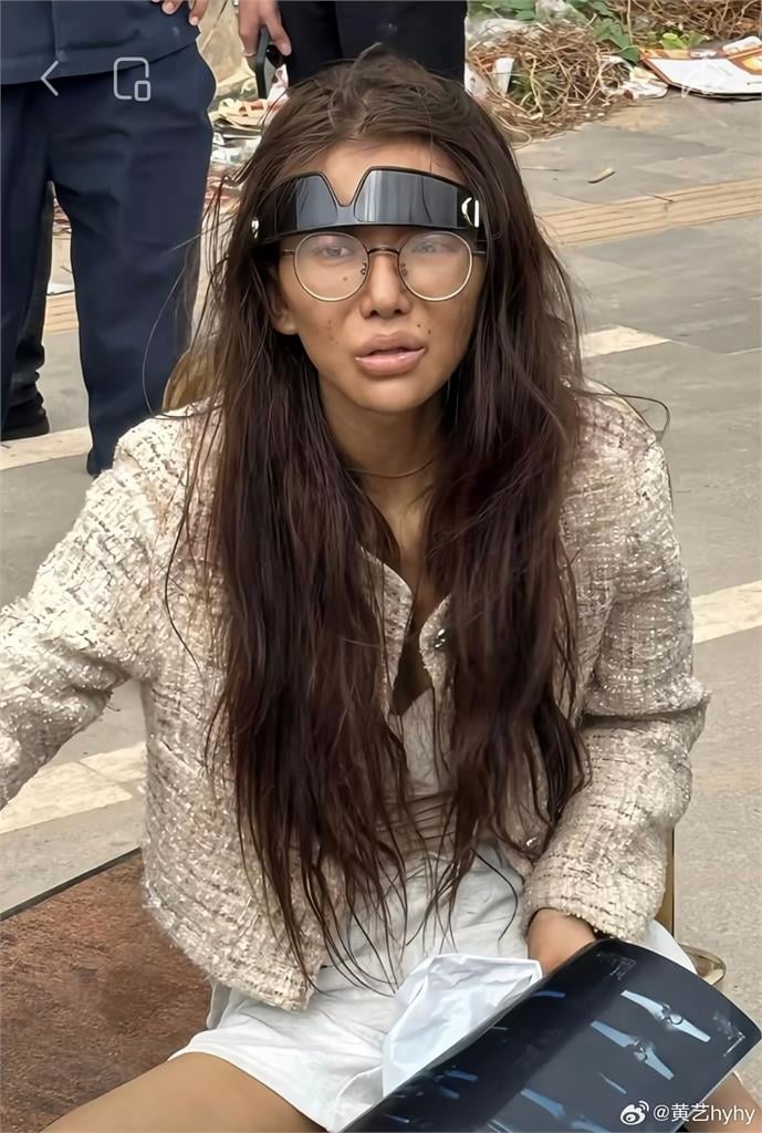 20歲女網紅遭斷腿丟包柬埔寨！網見她吃「八寶粥」曝暗黑內幕：牙被拔光
