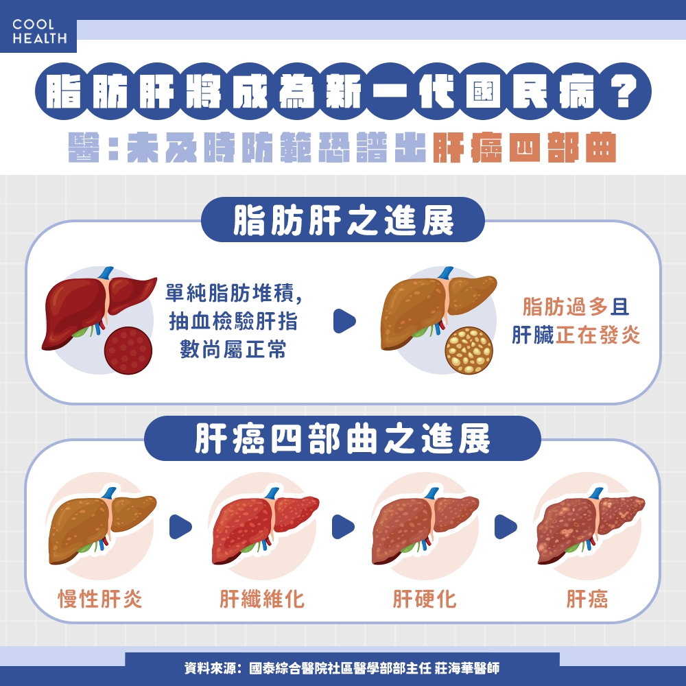 脂肪肝成為新一代「國民病」？ 未及時治療恐譜出「肝癌四部曲」