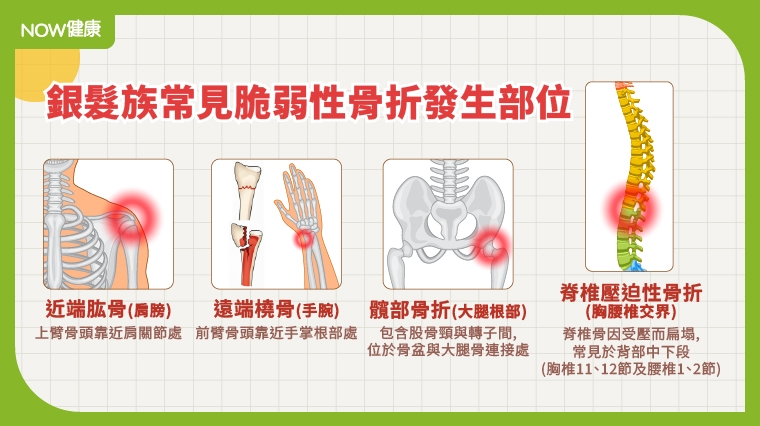 老人跌倒非小事！僅僅低能量衝擊也會帶來脆弱性骨折 掌握治療與照護關鍵防二次骨折