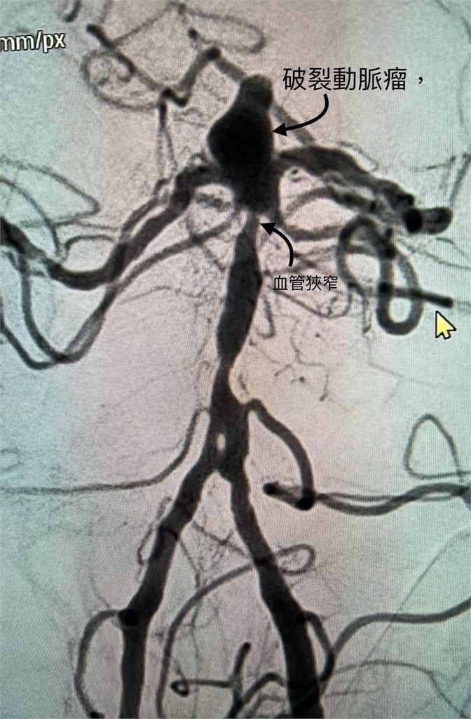 天冷血管急速收縮易釀「動脈瘤」爆裂　醫示警：1/3恐當場死亡