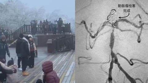 天冷血管急速收縮易釀「動脈瘤」爆裂　醫示警：1/3恐當場死亡