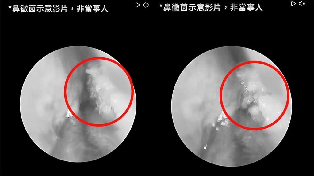 他口臭島老婆想離婚「刷牙也沒用」!醫一看元凶竟是「鼻子長滿黴菌球」畫面曝光