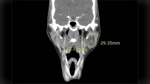 婦人左臉突然「凸」一塊！   4公分腫塊竟是少見腺細胞癌