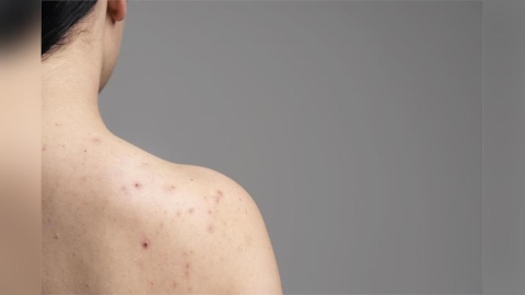 沒戴套惹禍！台中男確診M痘「成今年首例」　多名接觸者急匡列