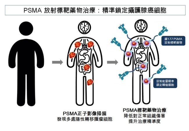 放射精準標靶治療讓診斷與治療合一　攝護腺癌控制邁入新里程碑