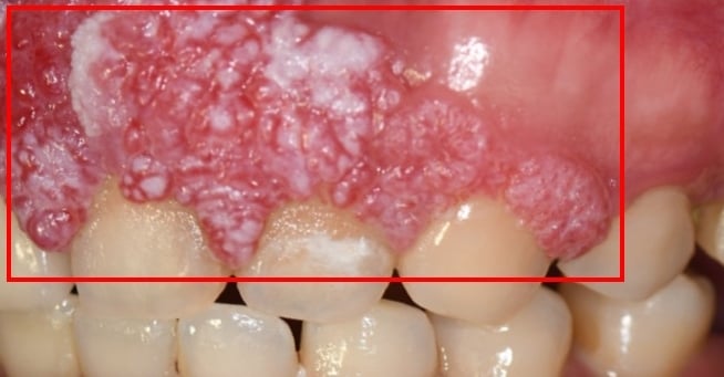 40歲女罹牙齦癌切掉「大半個上顎」!中山附醫1日3步驟助重建