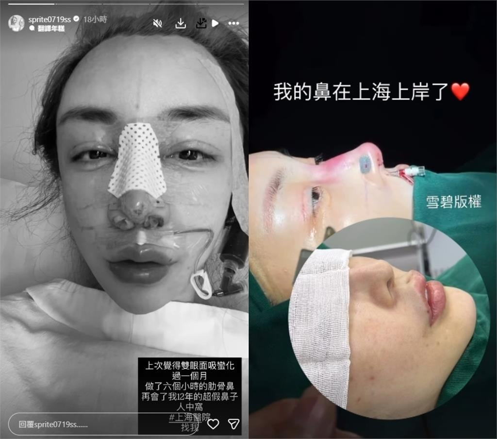 雪碧「12年假鼻」不要了！才爆「整形失敗」飛上海求醫⋯虛弱插管照流出
