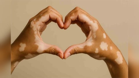 皮膚長白斑無藥可醫？什麼是白斑？如何停止擴散？治療方式一次看清！