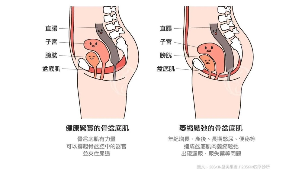 認識頻尿與漏尿相關議題：從骨盆底肌功能談日常照護與評估