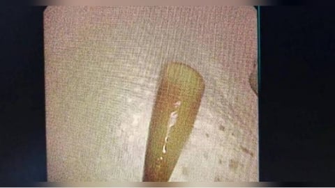 24歲男聚餐吐血送醫！醫生從肺部取出「這物」　他傻眼：小學弄丟的