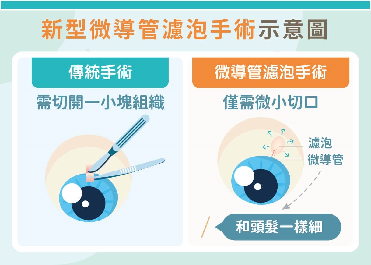 青光眼手術新選擇！微導管濾泡手術可降五成術後視力傷害