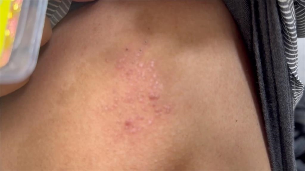 彰縣府皮蛇疫苗施打優惠 現場限量搶翻爆衝突