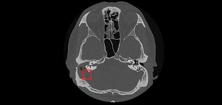 慢性中耳炎別輕忽! 老翁併發膽脂瘤引起神經功能損傷