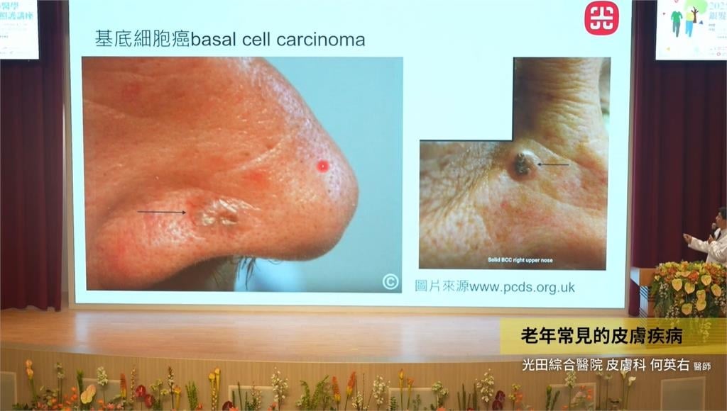 鼻頭黑痣長2年「突噴血」70歲翁險毀容！醫曝真相竟是長出「基底細胞癌」