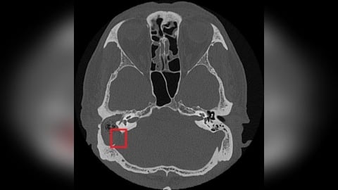 慢性中耳炎勿輕忽!小心併發膽脂瘤造成聽力與神經損傷