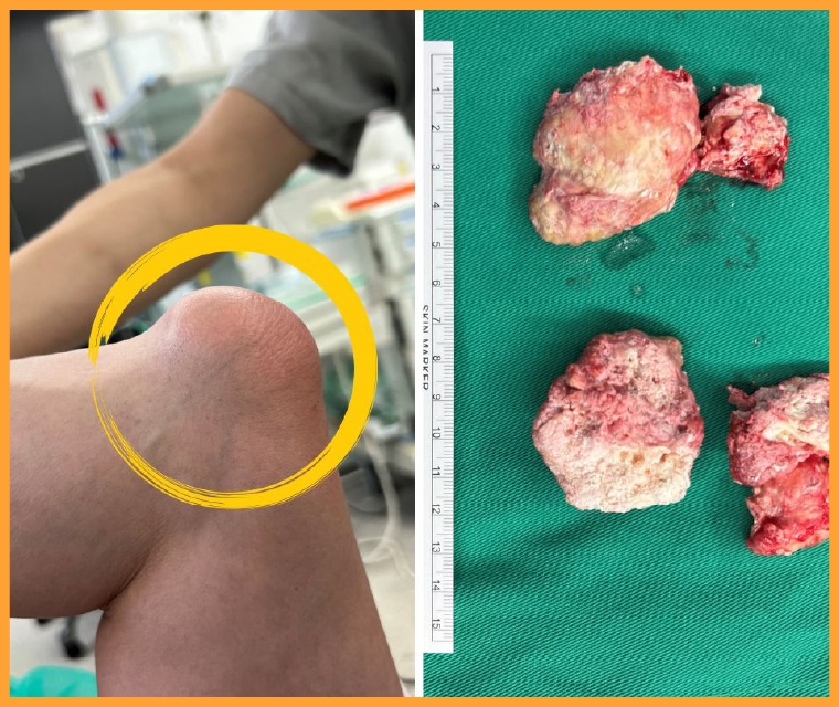 痛風石壓迫神經釀手麻！ 微創術後緩解 4症狀及早醫治 