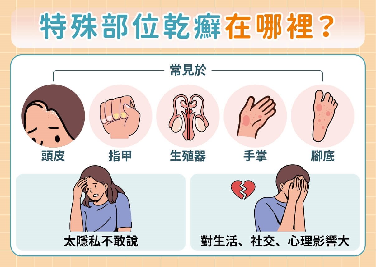 乾癬特殊部位難言之痛：治療新突破與溝通訣竅