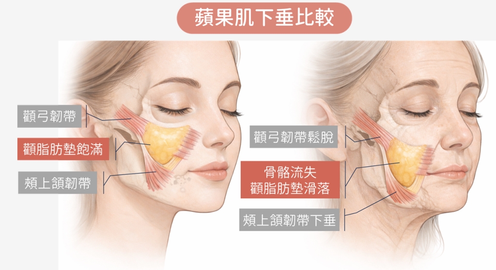 蘋果肌下垂怎麼辦？ 美女醫師教你 5 招重拾立體感