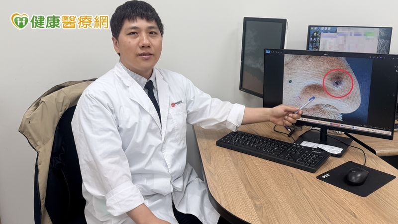 別輕忽不痛不癢的痣！七旬翁拖兩年竟變皮膚癌