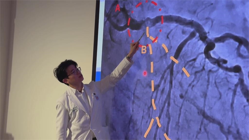72歲女子心臟血管「長石頭」 胸痛、冒冷汗一週險奪命