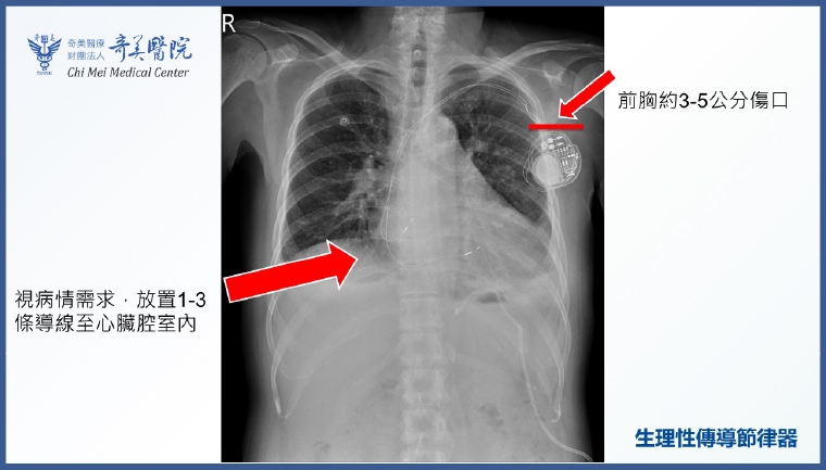心跳慢半拍恐威脅生命！ 生理性心臟節律器助精準起搏