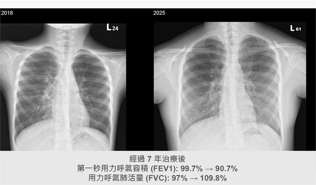 「罕見」不等於被忽略 北榮兒醫守護囊性纖維化患者13年