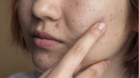 一顆一顆「閉鎖性粉刺」怎麼調整？專家解析3個日常處理方向