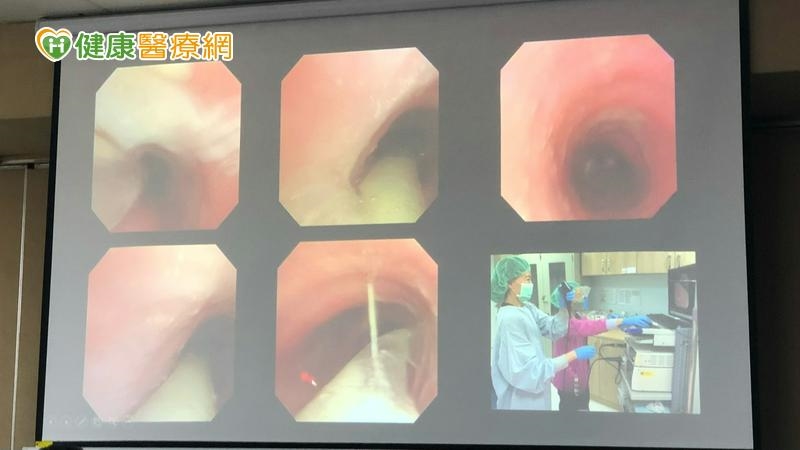 罕病「囊性纖維化」嚴重恐需肺移植　醫籲納新生兒篩檢防範未然