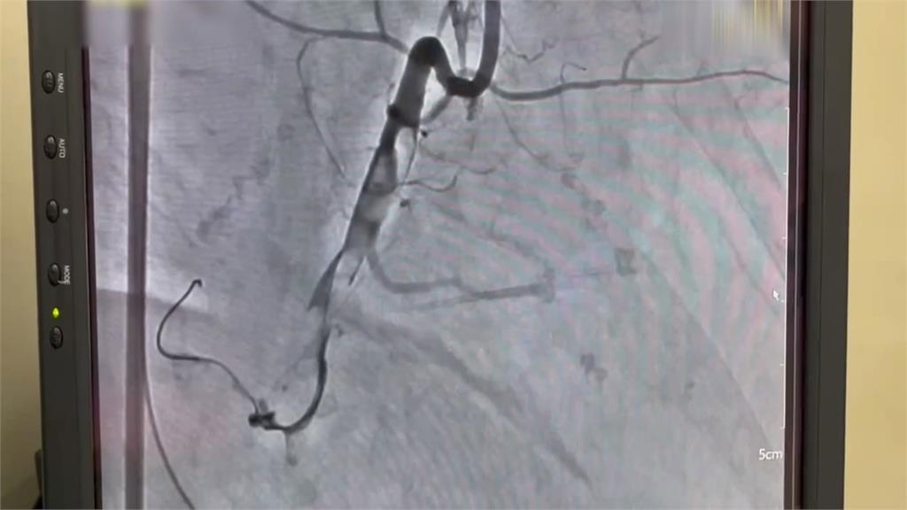 CPR搶命關鍵！　台中49歲男心肌梗塞OHCA奇蹟救回