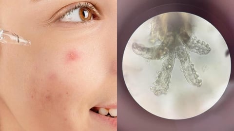 爛痘一年治不好！正妹臉上竟藏「百隻八腳蟲」狂繁殖...醫：妳餵飽牠們