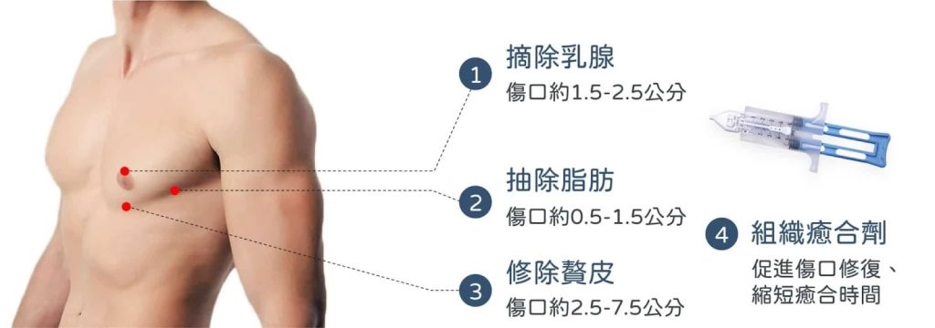 猛健樂瘦身仍甩不掉「肥仔波」？醫揭男性女乳症頑固真相