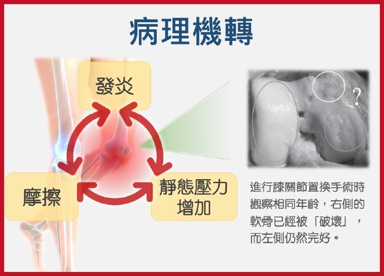 翻轉退化性關節炎迷思！ 「護膝333」口訣守護膝健康